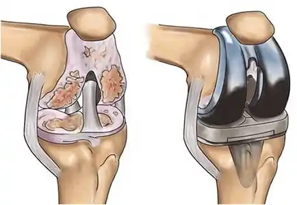 Knee Replacement