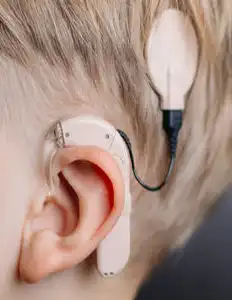 Everything You Need to Know About Cochlear Implants: Benefits, Risks, and How They Work