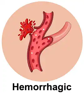 Hemorrhagic Stroke