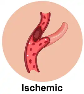 ischemic stroke