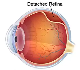 Detached Retina