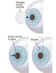 cornea transplant